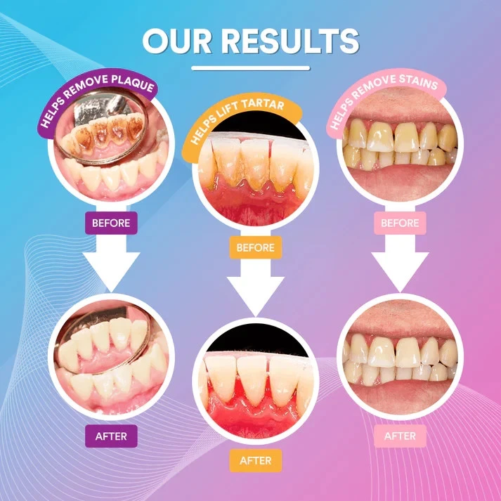Electric Plaque Remover for Teeth with 5 Modes Dental Sonic Tartar Tooth Cleaner thumbnail 13